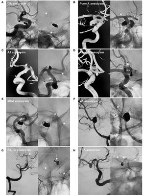 Application of the Neuroform Atlas Stent in Intracranial Aneurysms: Current Status